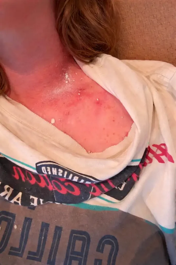 Which Bees Sting and Which Don’t: Bee Behavior and Safety 3 bee stung on a neck of a girl resulting in swelling
