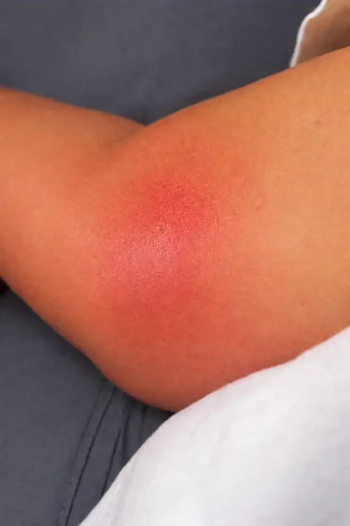 Do Bumble Bees Sting? Facts, Symptoms, and Safety Tips 6 Bumblebee sting on my arm after 36 hours